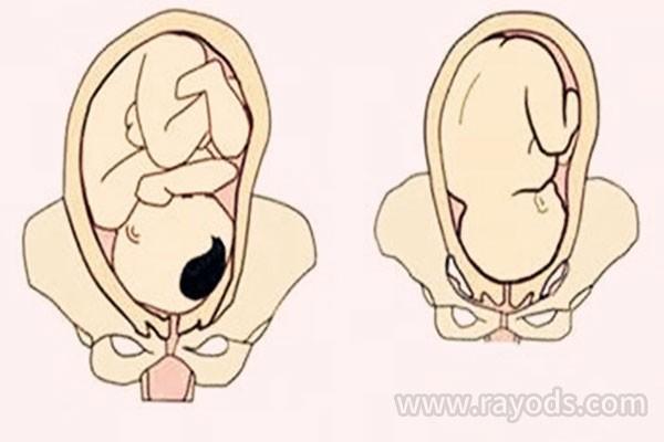 多胎妊娠的临床表现和症状是什么？恶心和呕吐