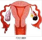 广州助孕产子花费-广州治疗巧克力囊肿的最佳方法